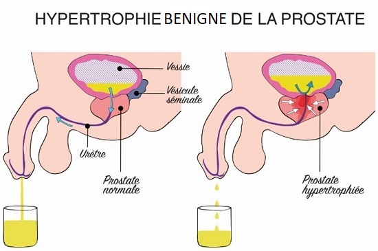 hypertrophie benine de la prostate